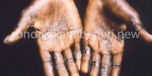 7 Soruda Maymun Çiçek Hastalığı Hakkında Bilgi