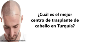 Los Mejores Centros De Trasplante Capilar De Turquía