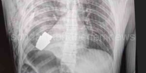 Askerin Vücudundan El Bombası Çıkarıldı