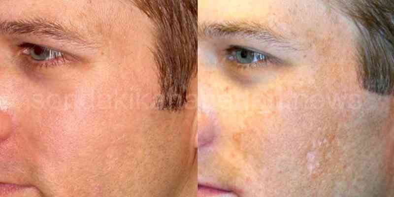 Dermapen Yaptırmak Zararlı Mı?