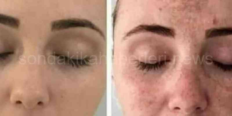 Dermapenin Zararları Nelerdir?