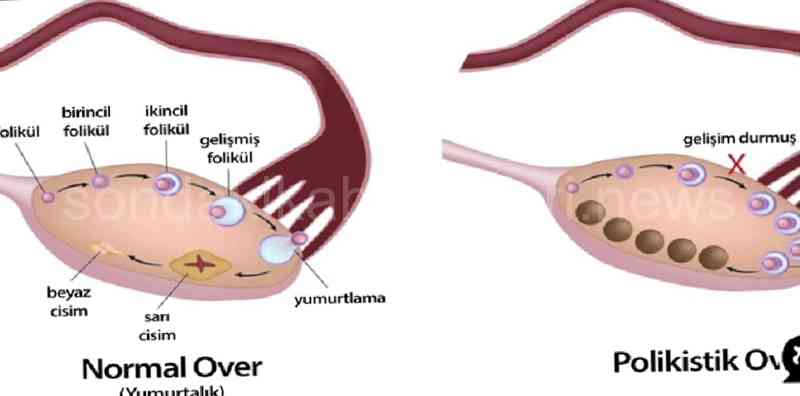 Polikistik Over Sendromu Neden Olur?
