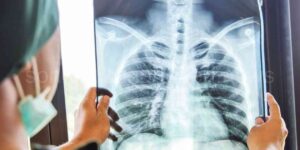Röntgenin Zararları Nelerdir?
