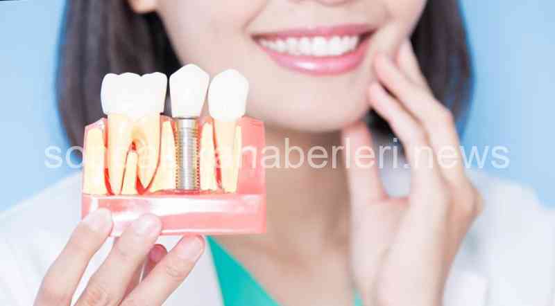 İmplant Nedir Ve Zararları Nelerdir? 2 İmplant Nedir Ve Zararları Nelerdir