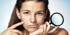 Sivilce Nasıl Geçer? Az Bilinen 3 Sivilce Yöntemi