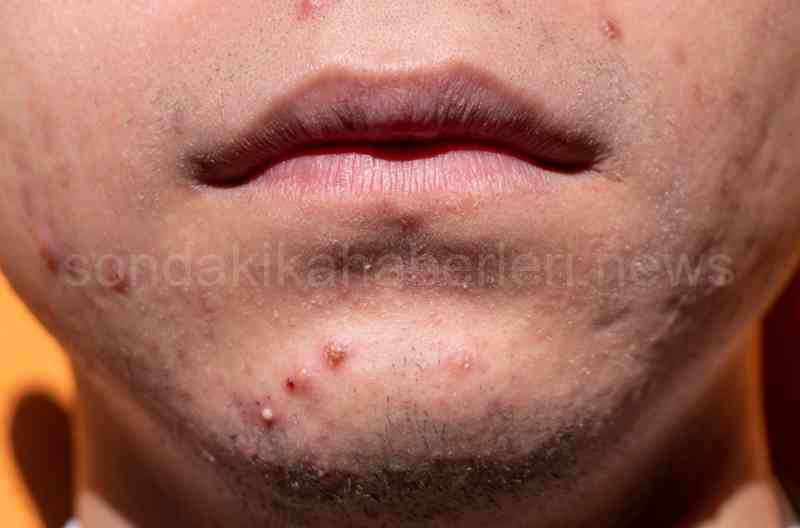 roaccutane nedir